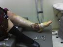 2007 Feb LauraBrokeLeg
